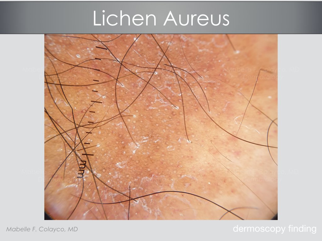 Saved by a dermatoscope – the tale of lichen aureus