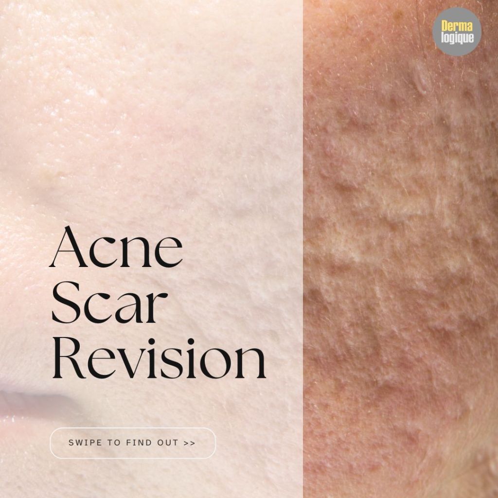 The ultimate guide on acne scar revision