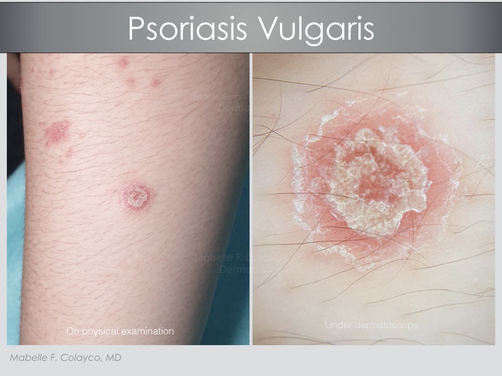 A look at psoriasis