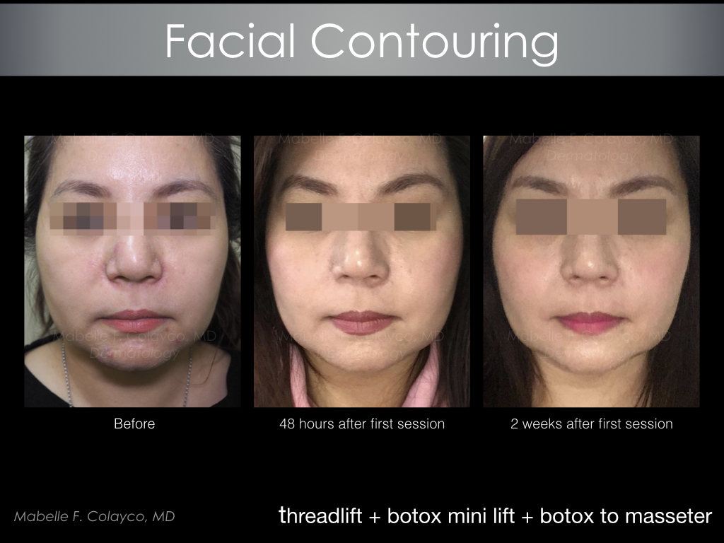 Improving the lower face using threads and botulinum toxin
