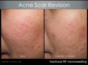 fractional RF needling