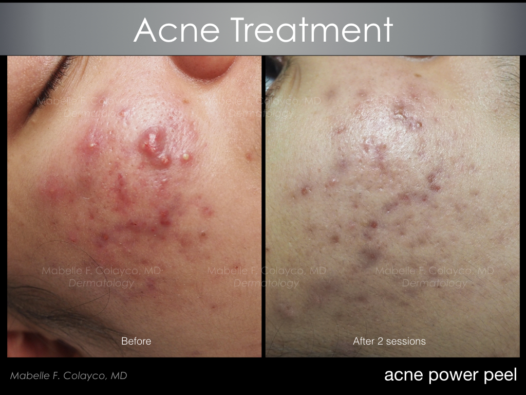 If you have moderate to severe acne…