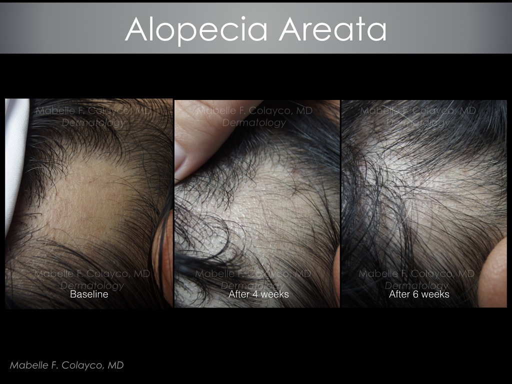 Bye bye bald&nbsp;spot!