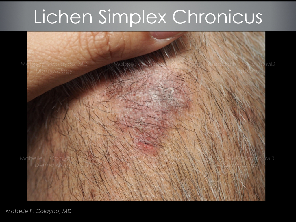 The itch-scratch cycle