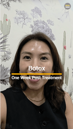 One Week After Botox: Face&nbsp;Reveal