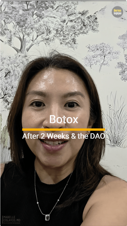 How Botox Looks Like After Two Weeks and More on the DAO