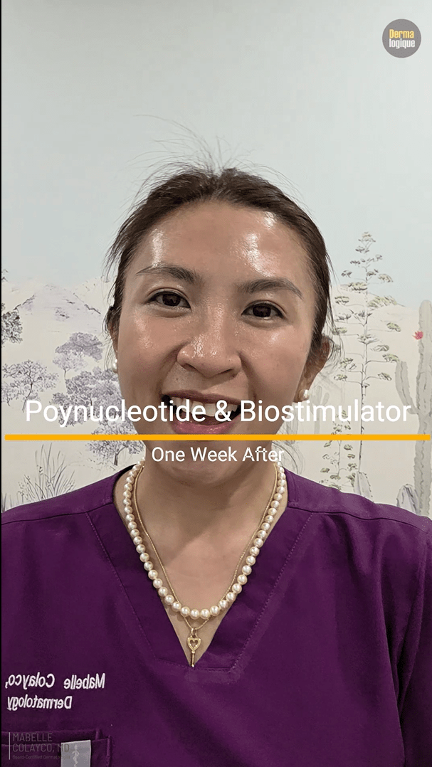 One Week After polynucleotide and Biostimulator&nbsp;Injections