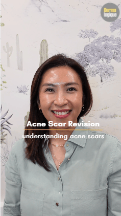 Understanding Acne Scar&nbsp;Revision